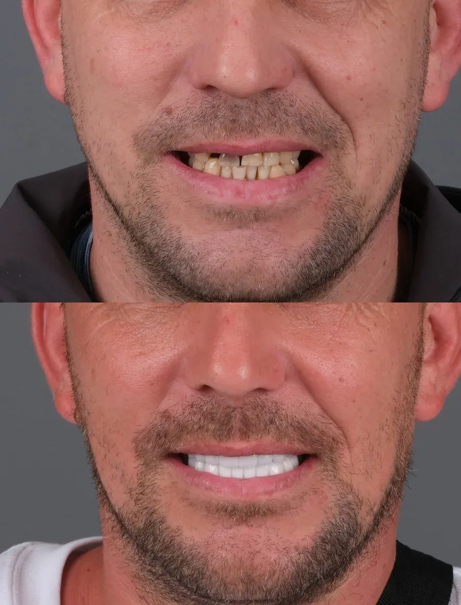 Before and after dental treatment result at DNT Klinik